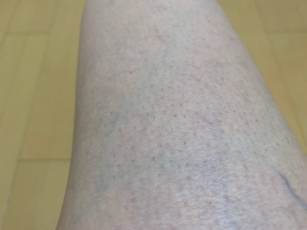 男の全身脱毛5回目の効果