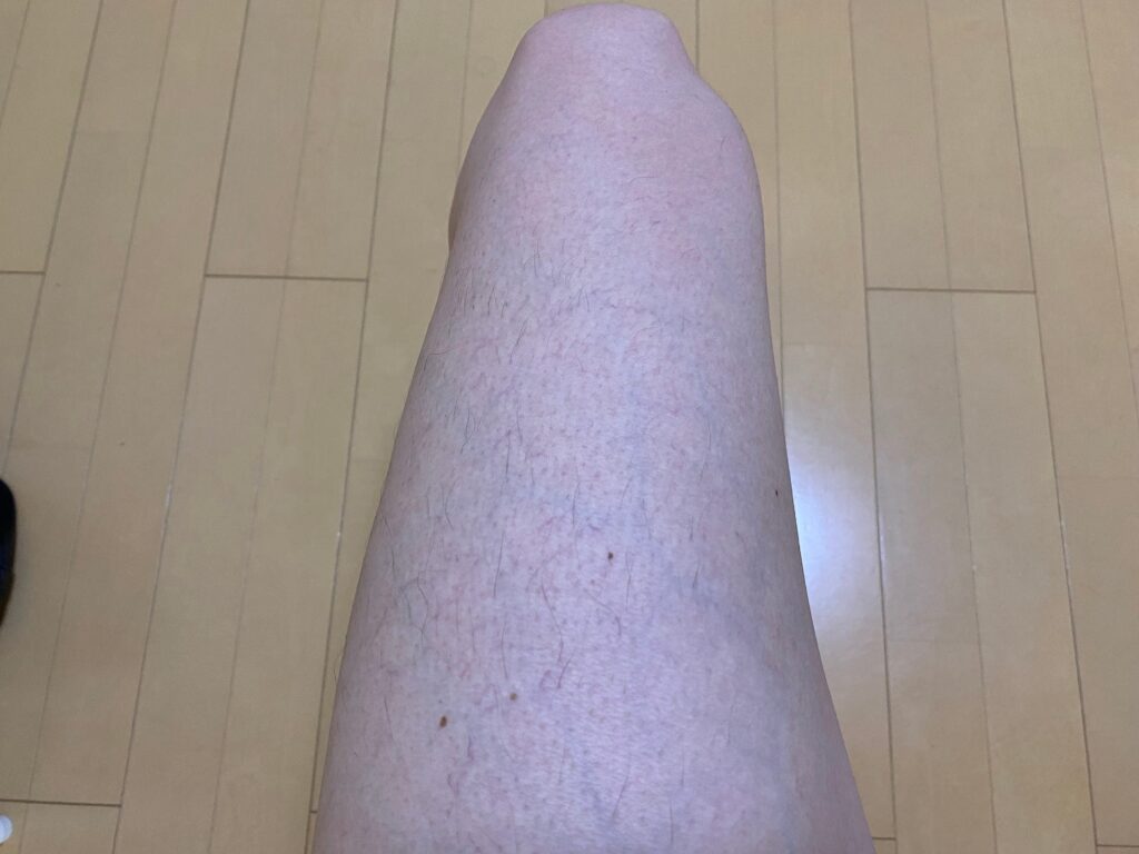 男の全身脱毛5回目の効果