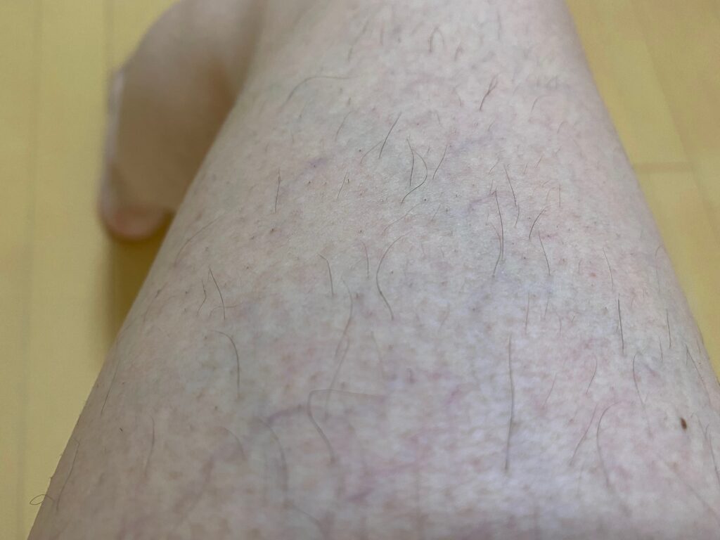 男の全身脱毛5回目の効果