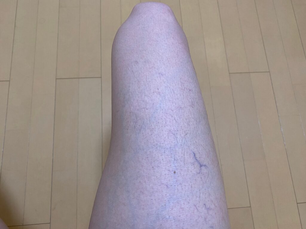 男の全身脱毛5回目の効果