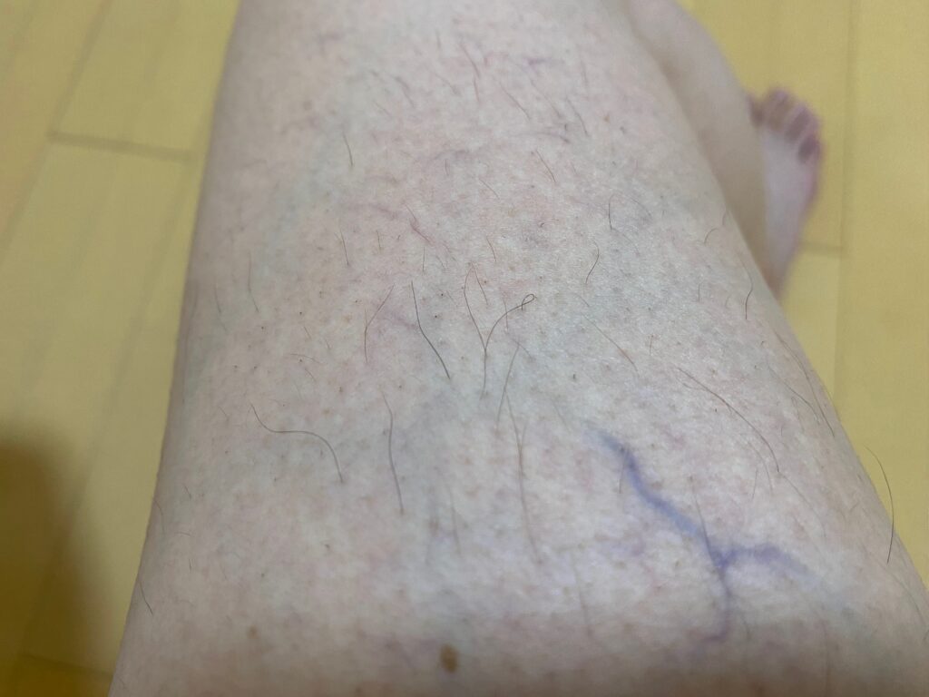 男の全身脱毛5回目の効果