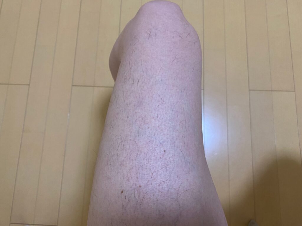 男の全身脱毛5回目の効果