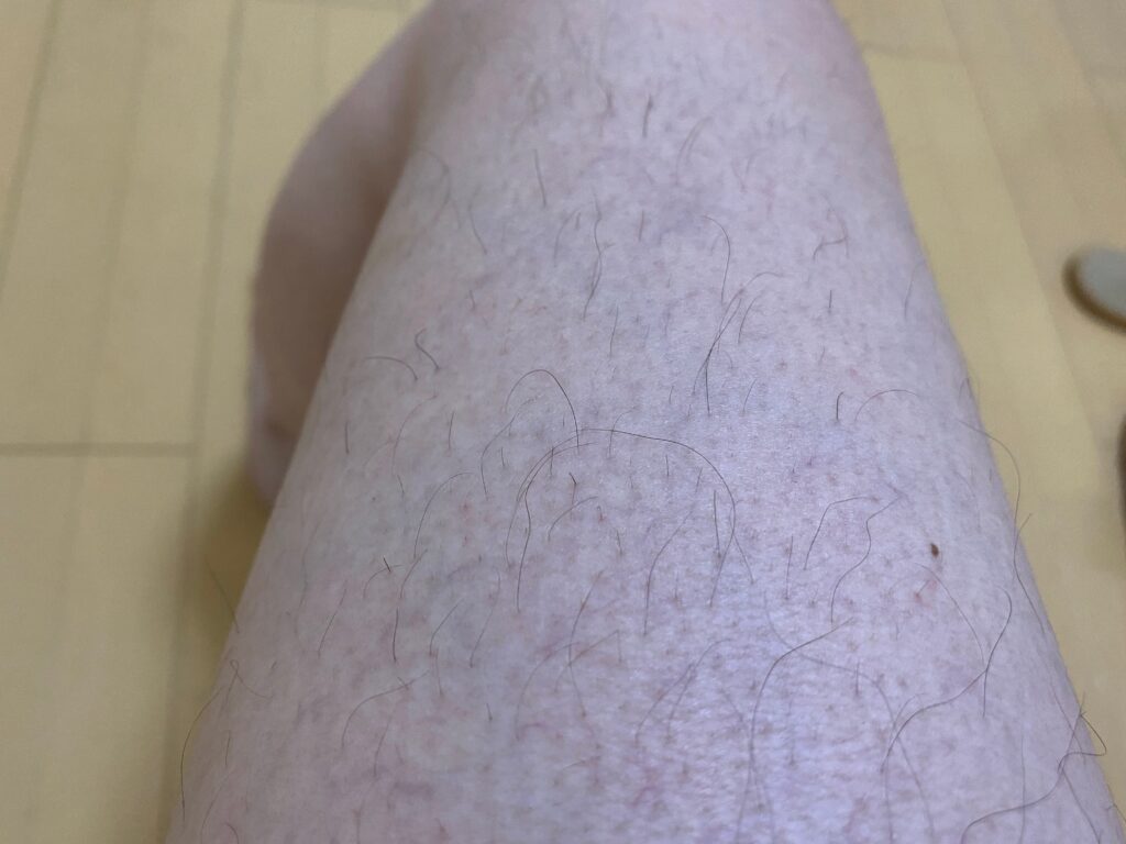 男の全身脱毛5回目の効果