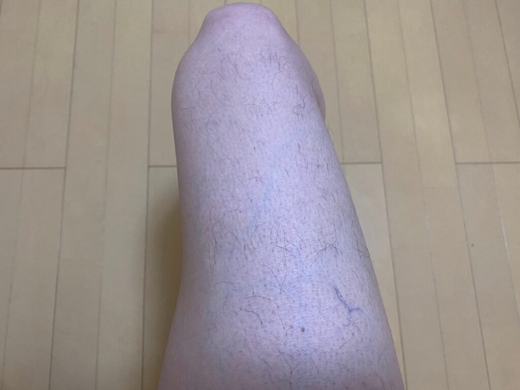 男の全身脱毛5回目の効果