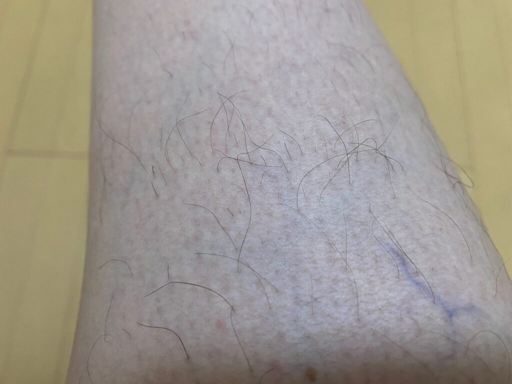 男の全身脱毛5回目の効果