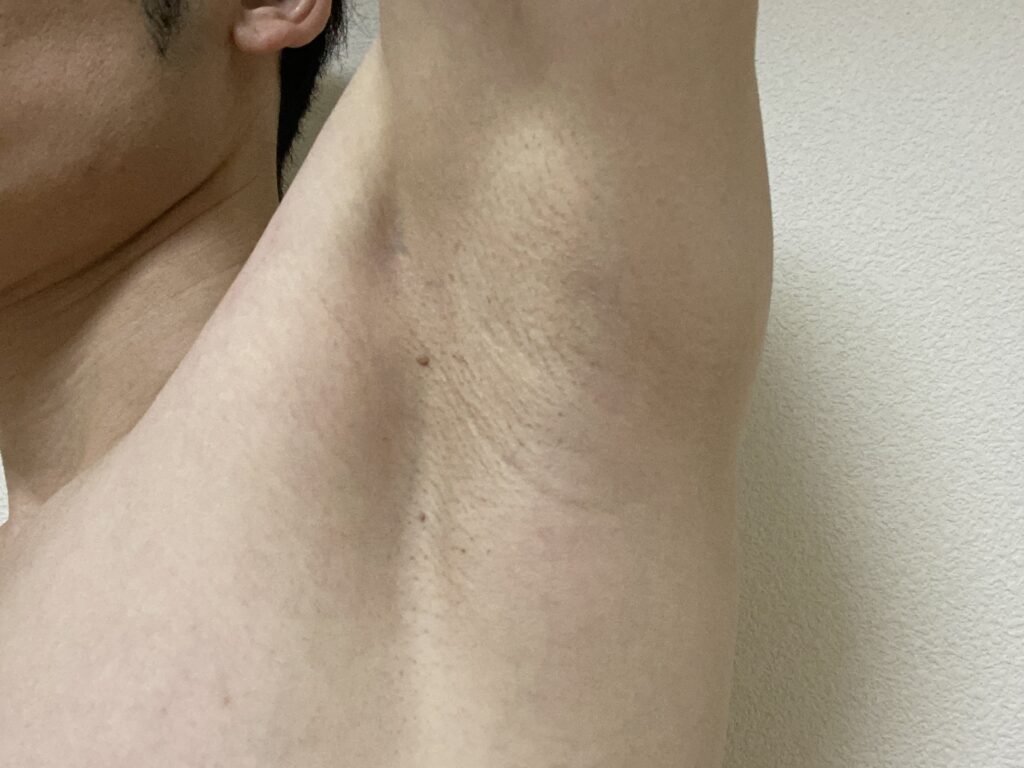 男の全身脱毛5回目の効果