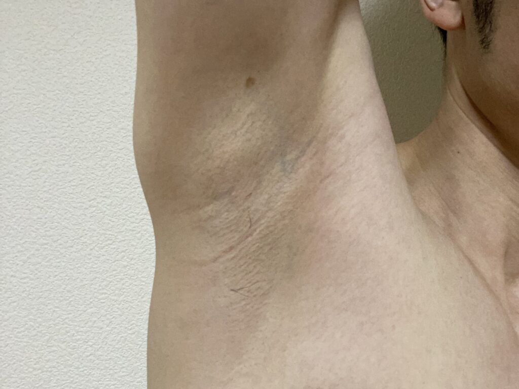 男の全身脱毛5回目の効果