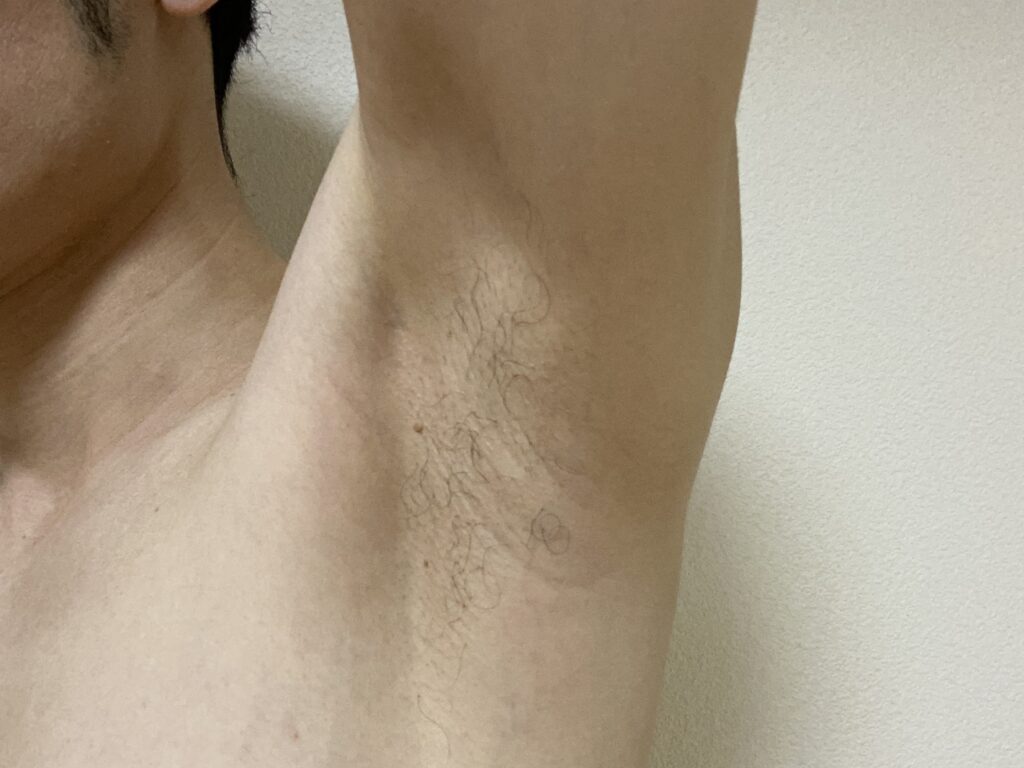 男の全身脱毛5回目の効果