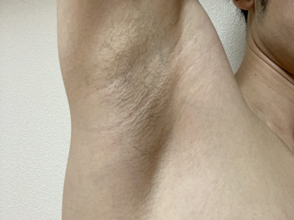 男の全身脱毛5回目の効果