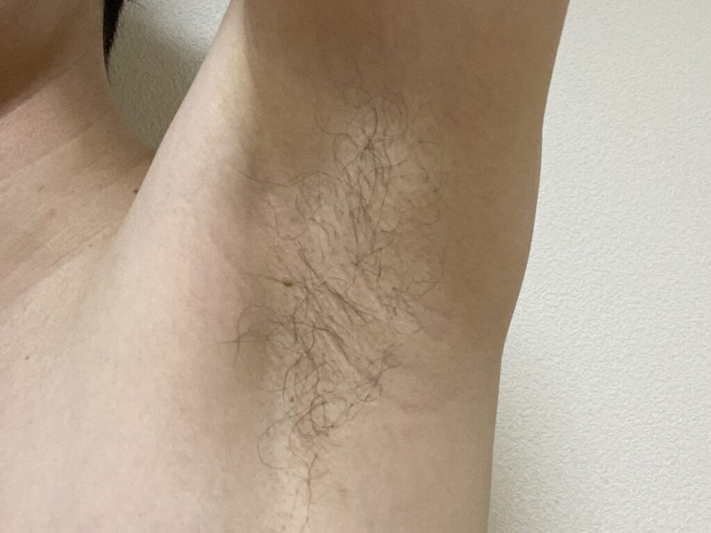 男の全身脱毛5回目の効果
