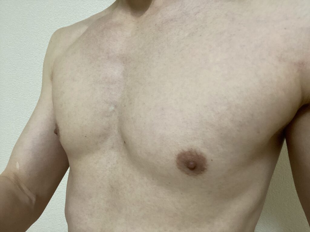 男の全身脱毛5回目の効果
