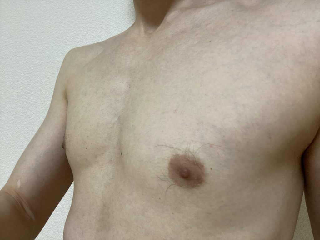 男の全身脱毛5回目の効果