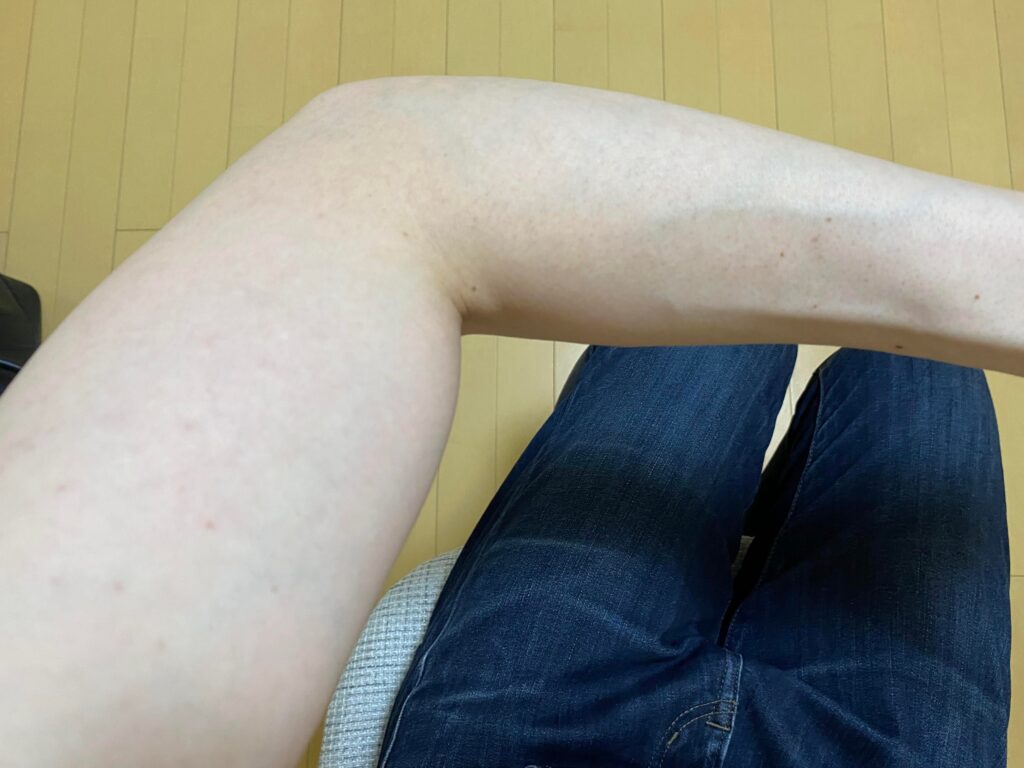 全身脱毛5回目の効果