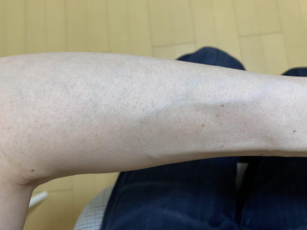 全身脱毛5回目の効果