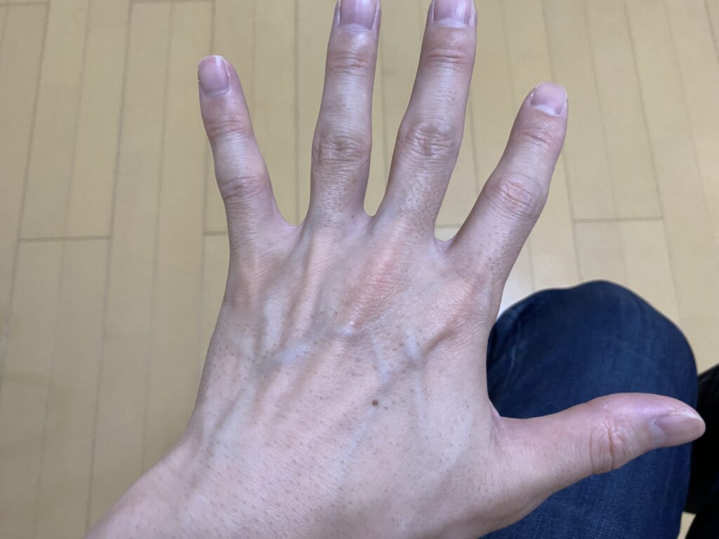 全身脱毛5回目の効果