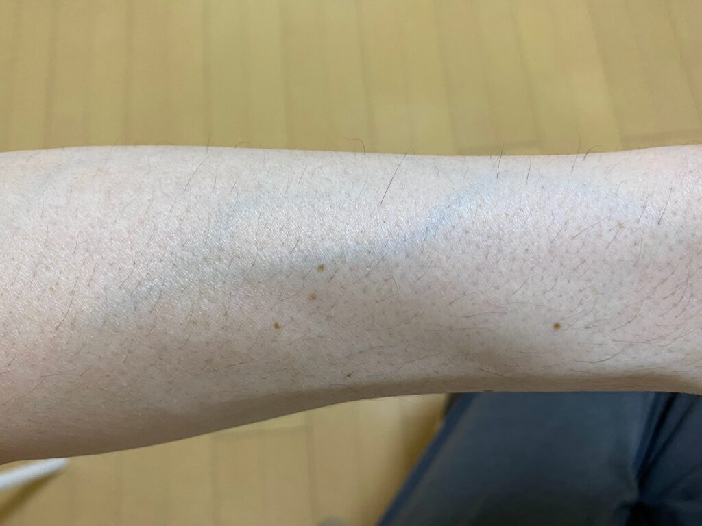 全身脱毛5回目の効果