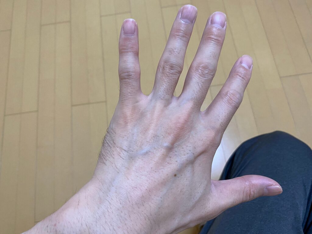 全身脱毛5回目の効果