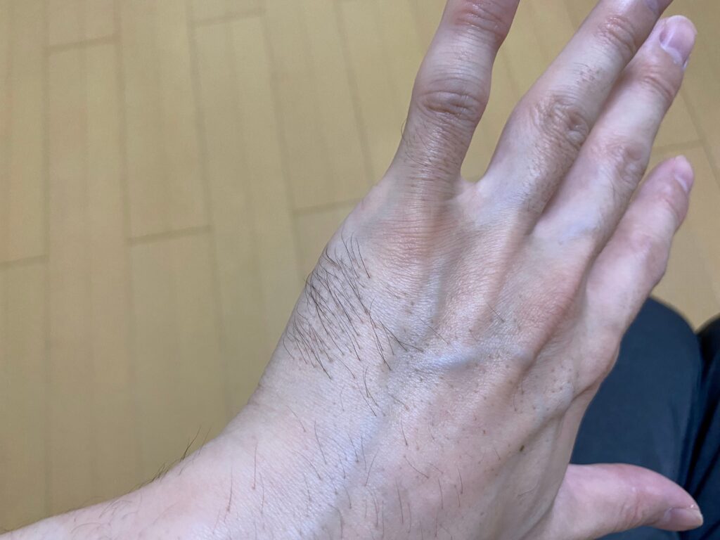 全身脱毛5回目の効果