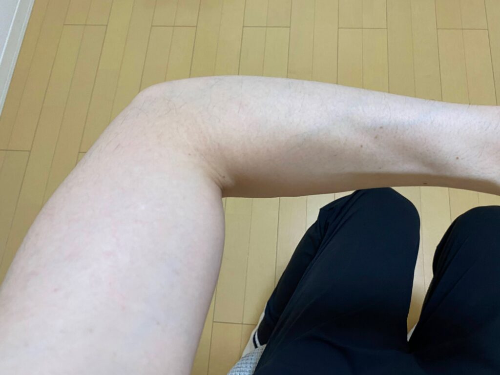 全身脱毛5回目の効果