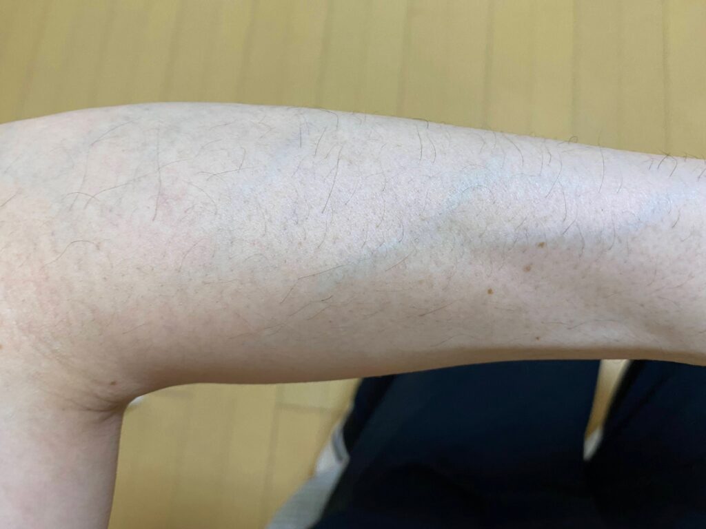 全身脱毛5回目の効果
