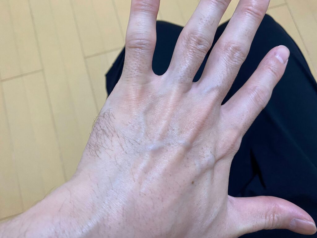 全身脱毛5回目の効果
