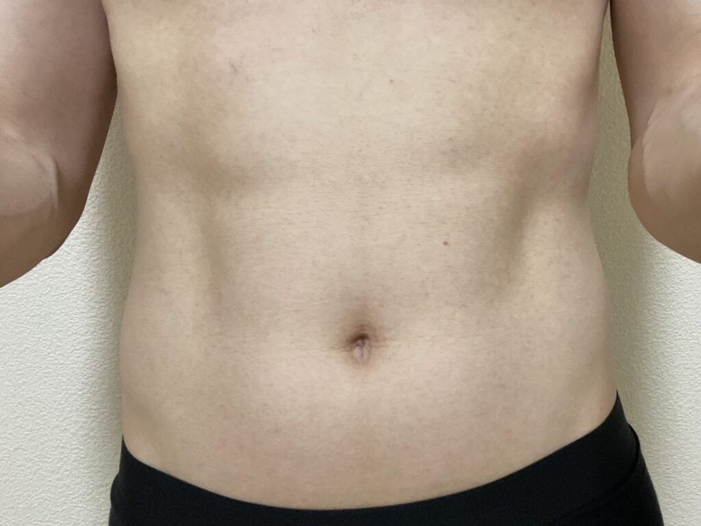 男の全身脱毛5回目の効果