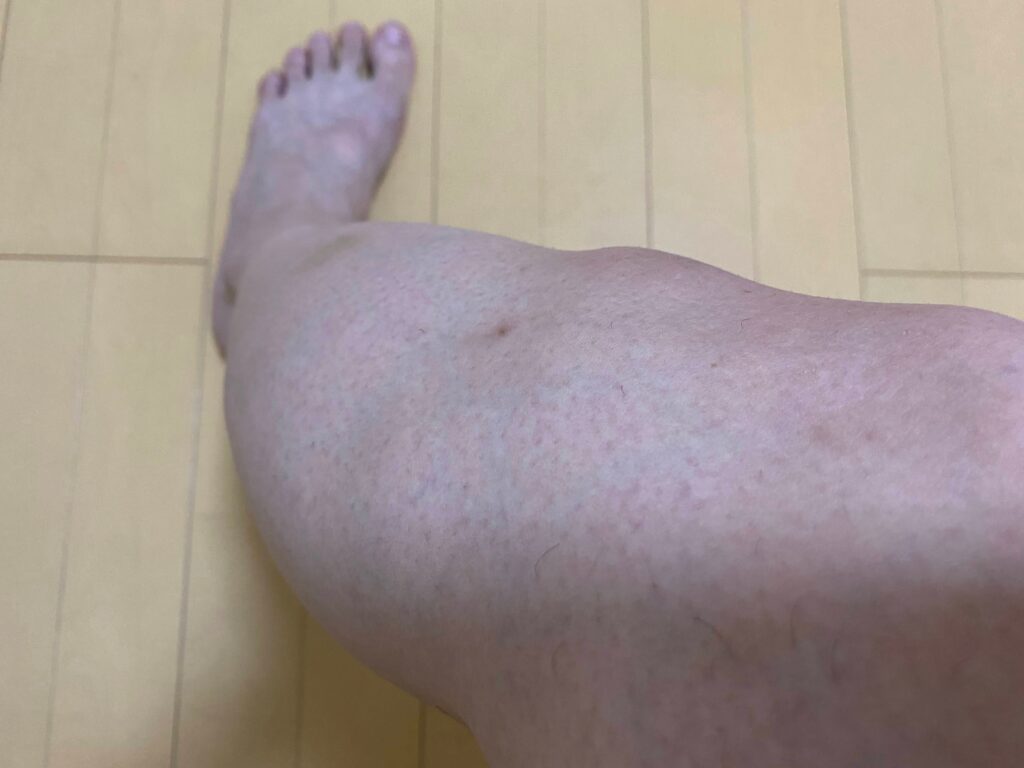 メンズ全身脱毛5回目の結果