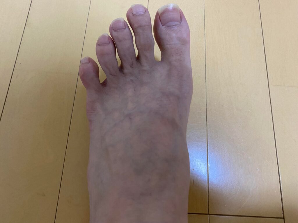 メンズ全身脱毛5回目の結果