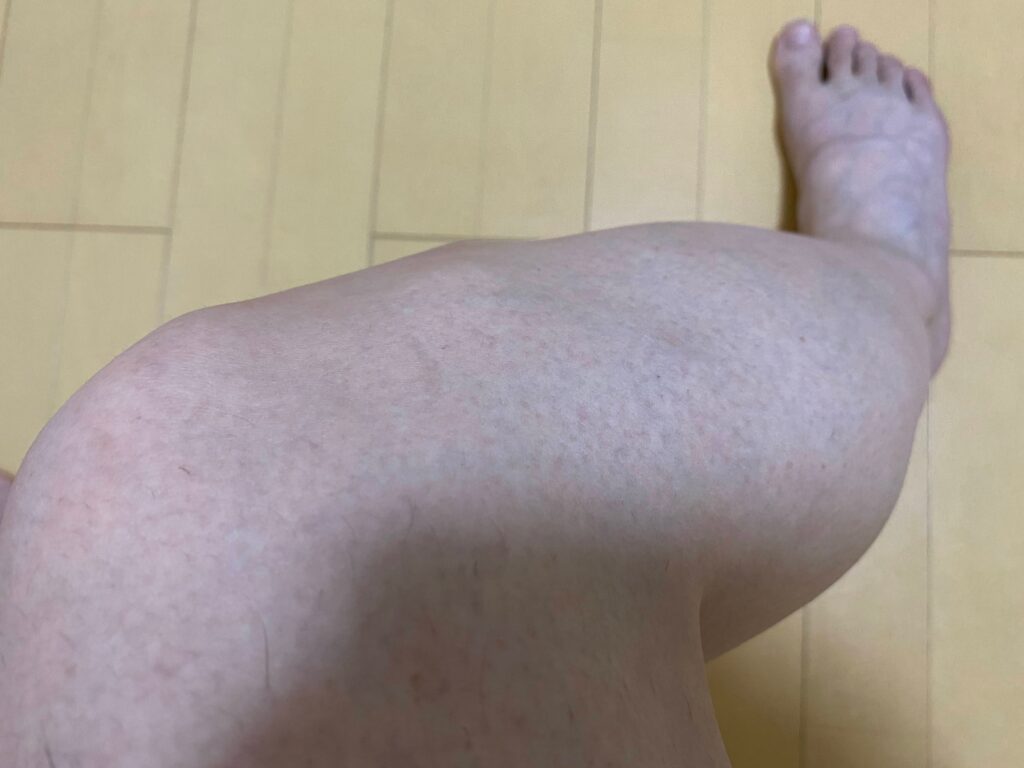 メンズ全身脱毛5回目の結果