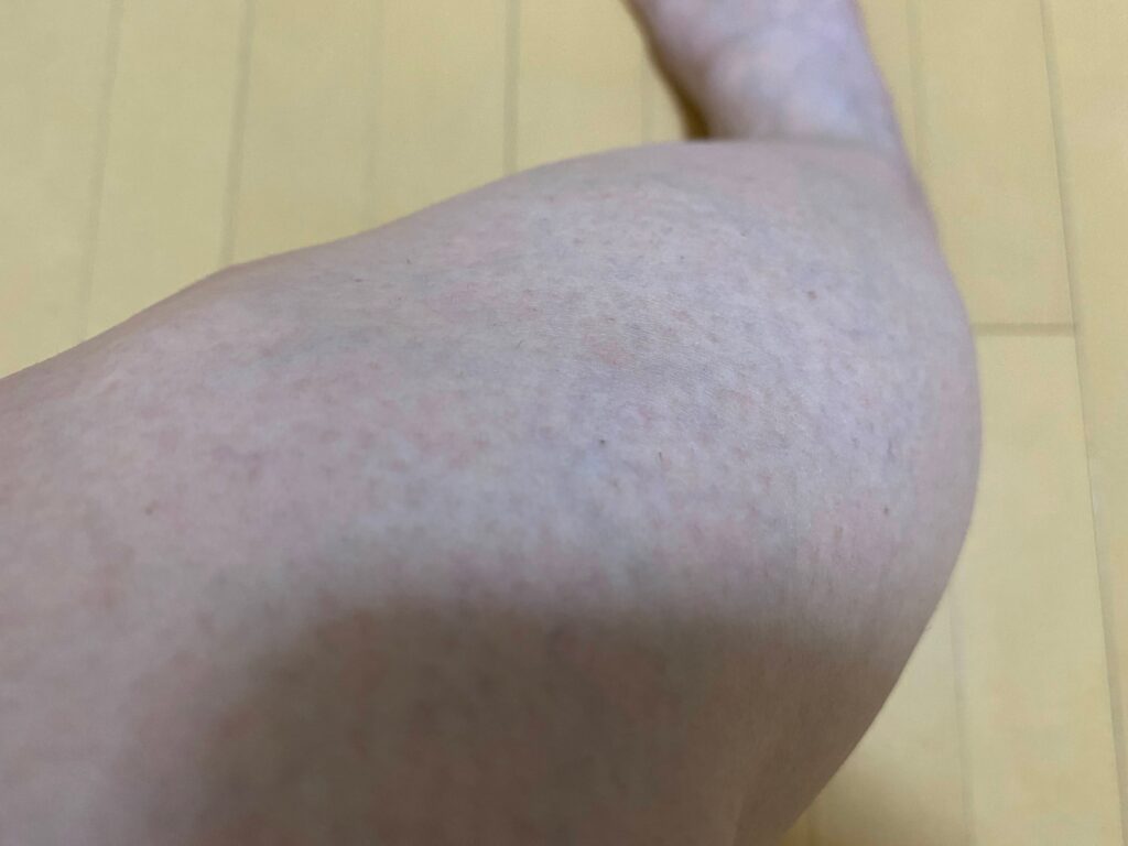 メンズ全身脱毛5回目の結果