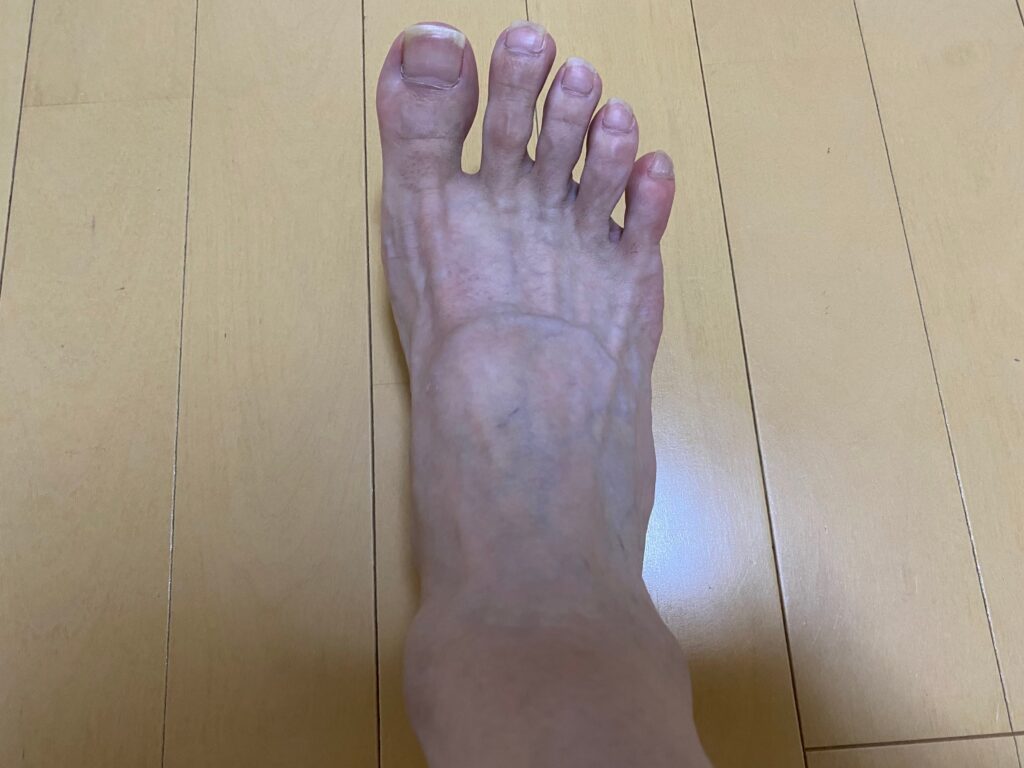 メンズ全身脱毛5回目の結果