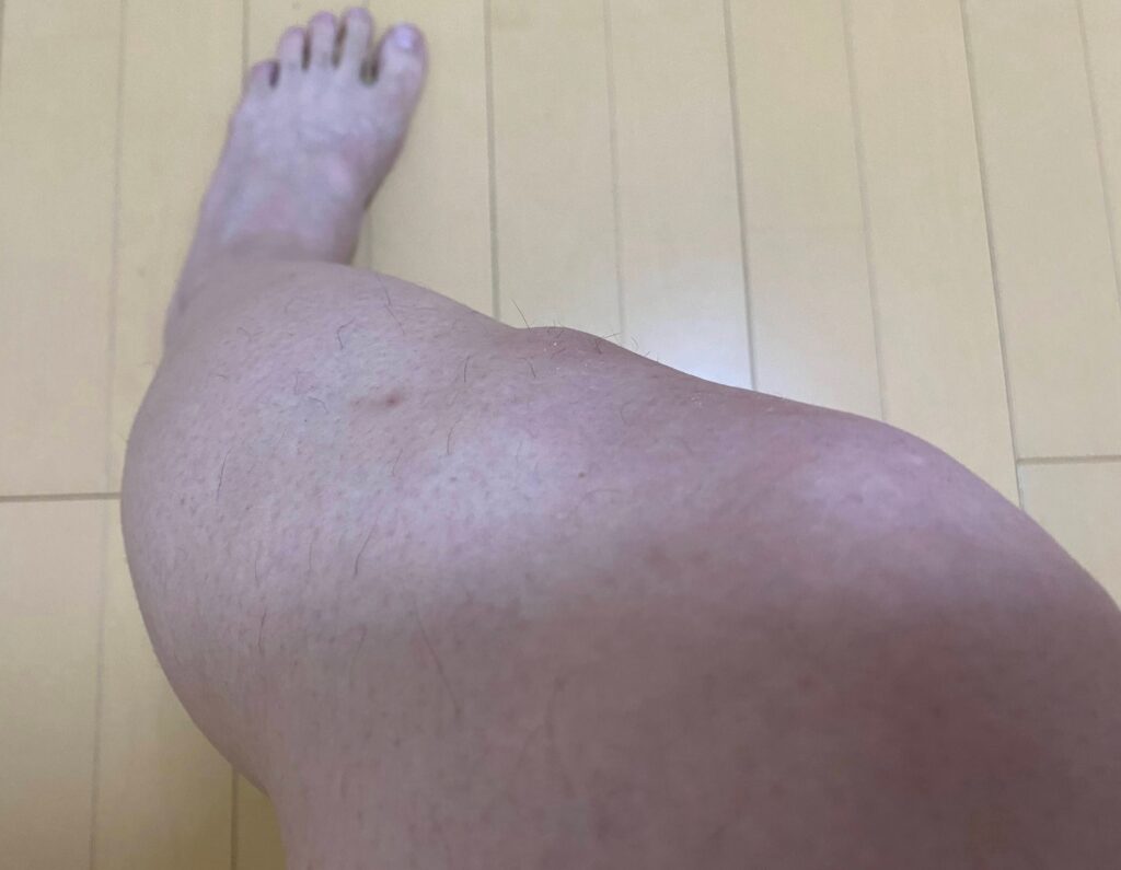 メンズ全身脱毛5回目の結果