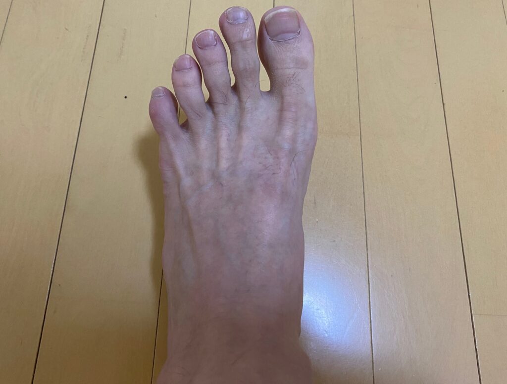メンズ全身脱毛5回目の結果