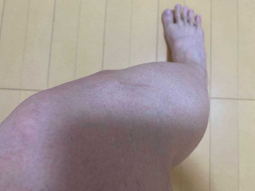 メンズ全身脱毛5回目の結果