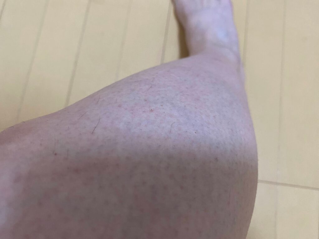 メンズ全身脱毛5回目の結果