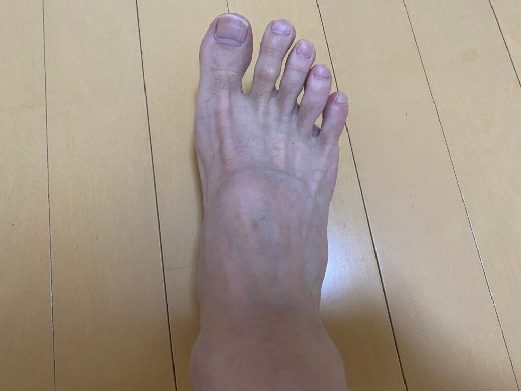メンズ全身脱毛5回目の結果