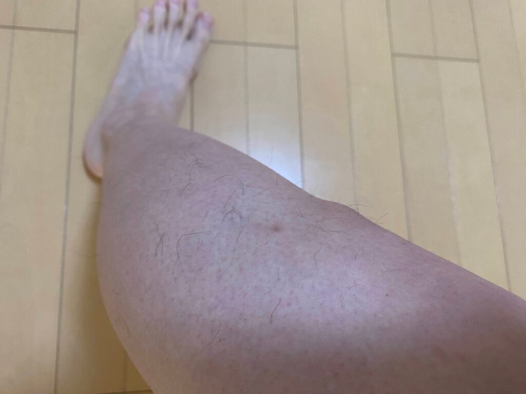 メンズ全身脱毛5回目の結果