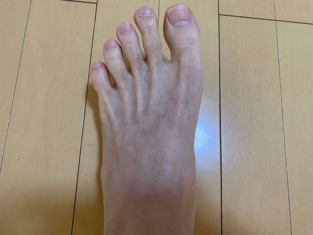 メンズ全身脱毛5回目の結果