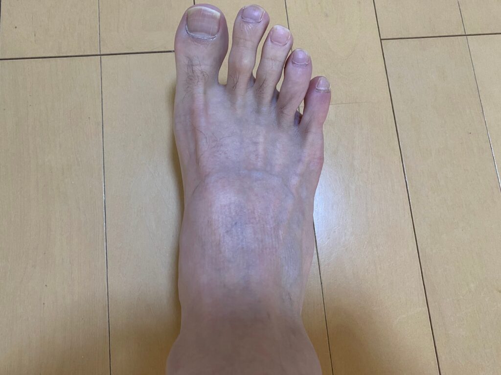 メンズ全身脱毛5回目の結果