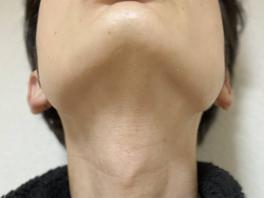ヒゲ脱毛25回目の効果