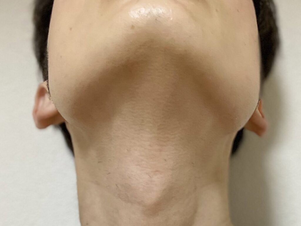 ヒゲ脱毛25回目の効果